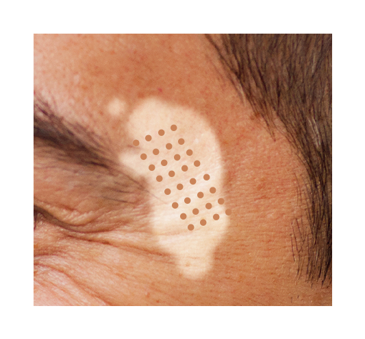 SST 피부이식술 이미지