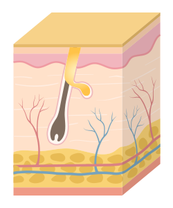 여드름 발생 과정 이미지