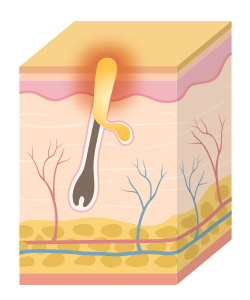 여드름 발생 과정 이미지