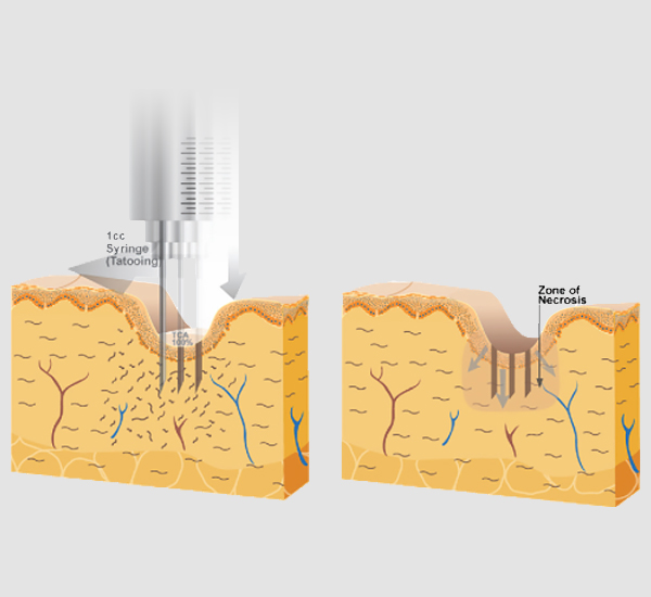 크로스 시술 이미지