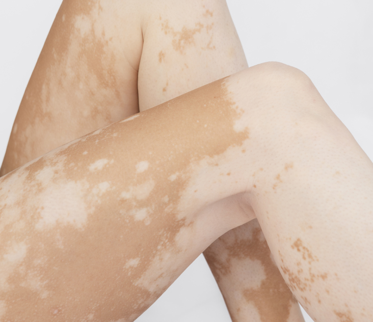 백반증 치료 주의사항