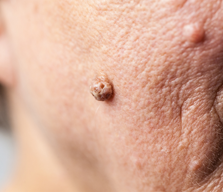 사마귀 치료 주의사항